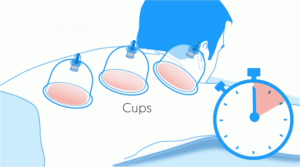 cupping2 3