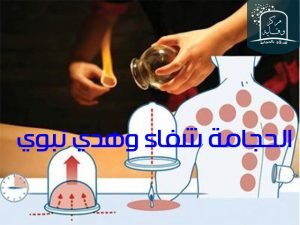 الحجامة شفاء وهدي نبوي 3