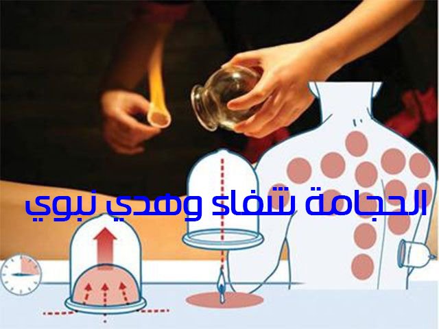 الحجامة شفاء وهدي نبوي
