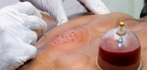 الحجامة لعلاج آلام الظهر 3