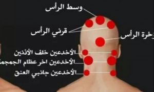فوائد الحجامة في وسط الرأس 3