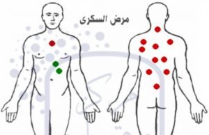 مرضى السكري 2 3