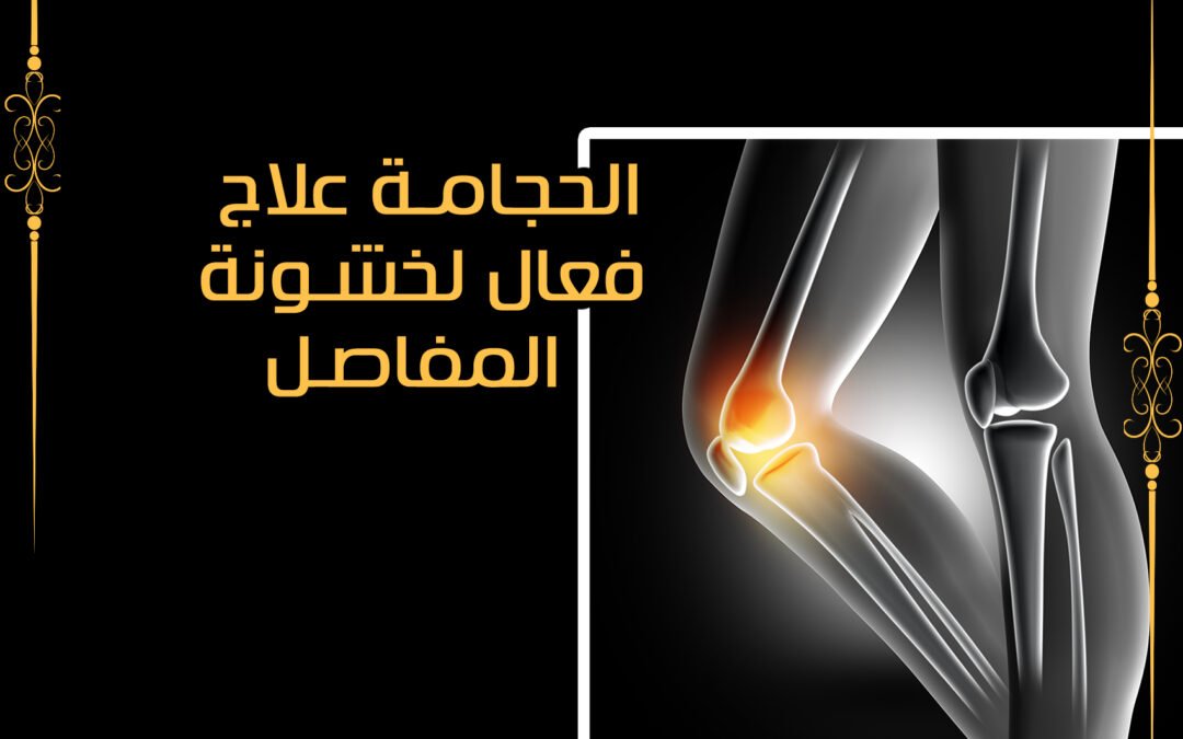 الحجامة علاج فعال لخشونة المفاصل وآلام العظام