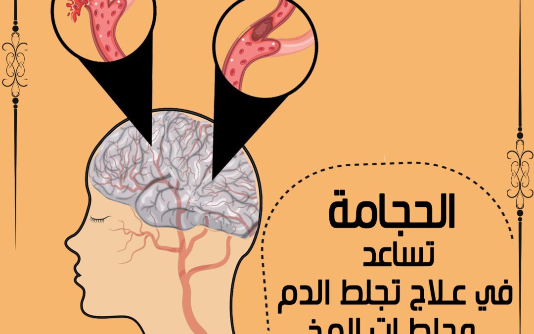 الحجامة تساعد في علاج تجلط الدم وجلطات المخ