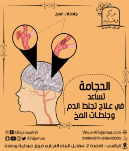 الحجامة تساعد في علاج تجلط الدم وجلطات المخ 3