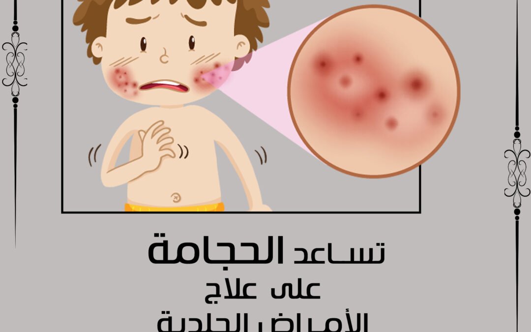 الحجامة تساعد في علاج المراض الجلدية