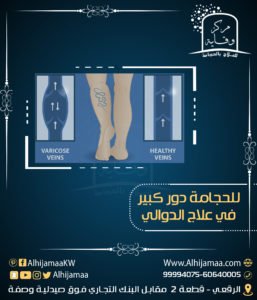 الحجامة تساعد في علاج الدوالي 3